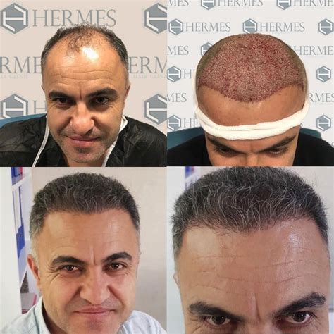 hermes hair transplant reviews